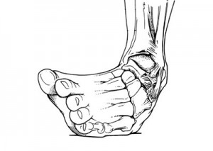 Sprained-Ankle