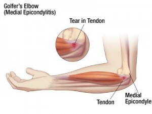 Golfers-Elbow